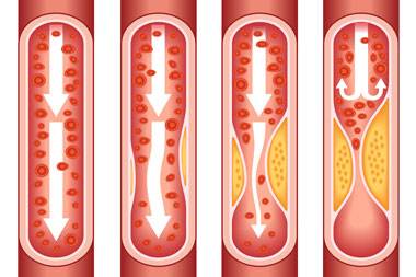 cardiology-conditions-coronary-artery-disease-cad
